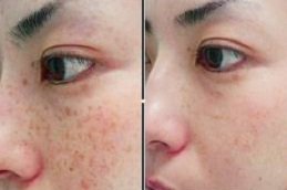 Pigmentation Treatment in Riyadh & Saudi Arabia at Aesthetic Clinic