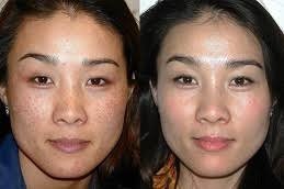 Pigmentation Treatment in Riyadh & Saudi Arabia at Aesthetic Clinic