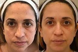 Pigmentation Treatment in Riyadh & Saudi Arabia at Aesthetic Clinic