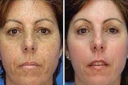 Pigmentation Treatment in Riyadh & Saudi Arabia at Aesthetic Clinic