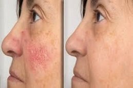 Rosacea treatment in Riyadh & Saudi Arabia