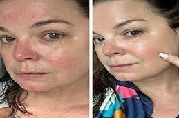 Rosacea treatment in Riyadh & Saudi Arabia