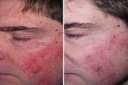 Rosacea treatment in Riyadh & Saudi Arabia