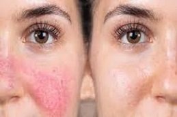 Rosacea treatment in Riyadh & Saudi Arabia