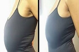 Scarless breast augmentation in Riyadh & Saudi Arabia