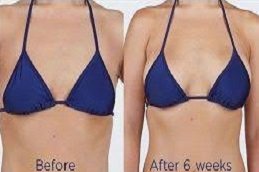 Scarless breast augmentation in Riyadh & Saudi Arabia