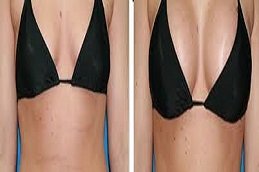 Scarless breast augmentation in Riyadh & Saudi Arabia