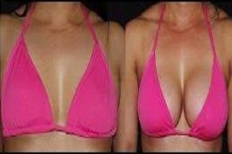 Scarless breast augmentation in Riyadh & Saudi Arabia