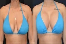 Short Scar Breast Augmentation in Riyadh and Saudi Arabia