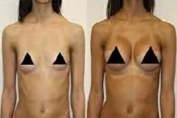 Short Scar Breast Augmentation in Riyadh and Saudi Arabia