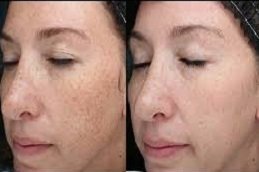 Skin Care treatment in Riyadh and Saudi Arabia