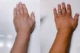 Tan removal in Riyadh & Saudi Arabia