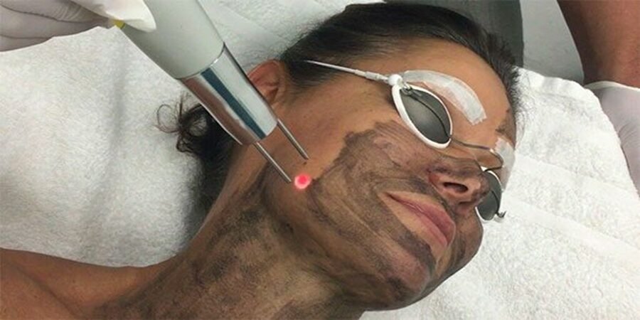 Laser carbon peel cost in Riyadh