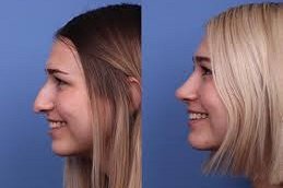 Rhinoplasty surgery in Jeddah