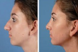 Rhinoplasty surgery in Jeddah