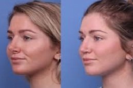 Rhinoplasty surgery in Jeddah