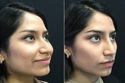 Rhinoplasty surgery in Jeddah