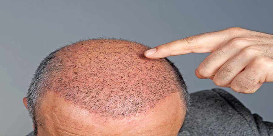 4000 or 5000 grafts hair transplant cost