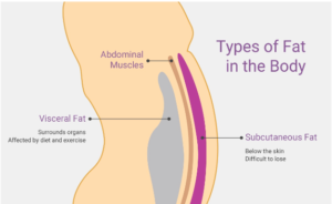 laser liposuction