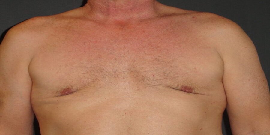 Gynecomastia surgery cost in Riyadh