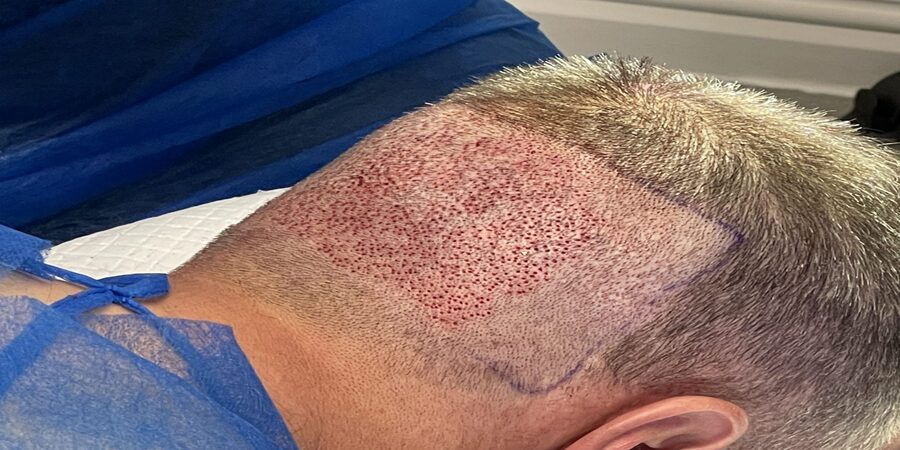 Does Hair Transplant Leave Scars