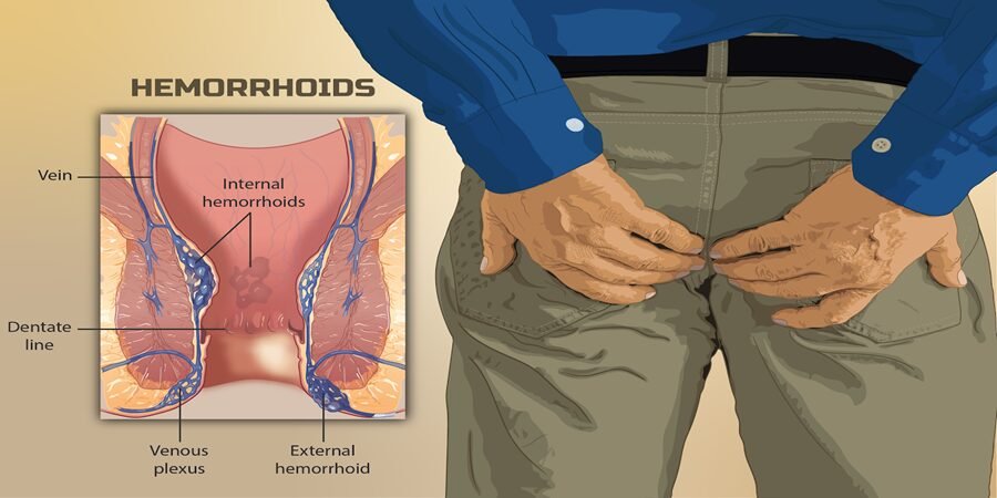 hemorrhoid treatment cost in Riyadh