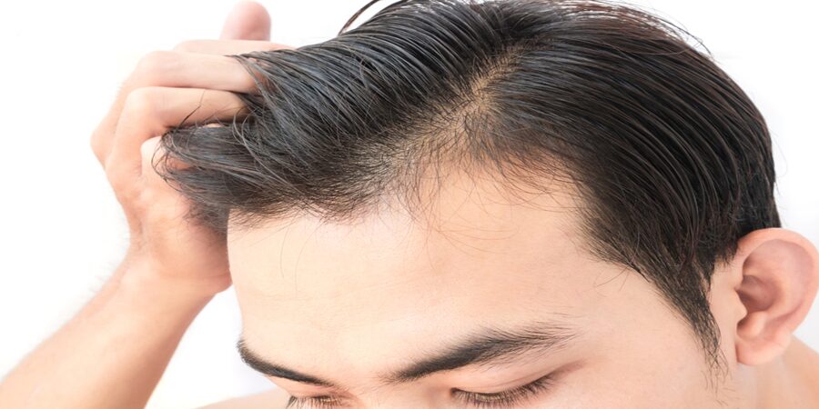 Use Of Mini And Micro Grafts In Hair Transplant In Riyadh