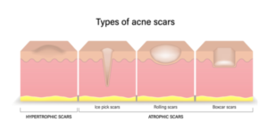 acne scars types