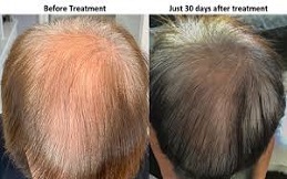 Exosome Therapy For Hair Loss In Riyadh