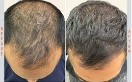 Exosome Therapy For Hair Loss In Riyadh