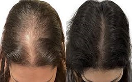 Exosome Therapy For Hair Loss In Riyadh