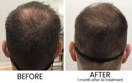 Exosome Therapy For Hair Loss In Riyadh