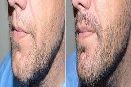 Beard Hair Transplant in Riyadh & Saudi Arabia