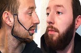 Beard Hair Transplant in Riyadh & Saudi Arabia
