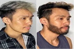 Beard Hair Transplant in Riyadh & Saudi Arabia