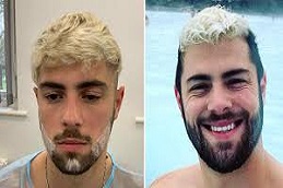 Beard Hair Transplant in Riyadh & Saudi Arabia