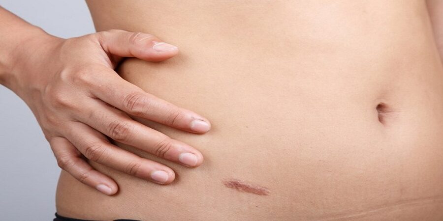 Surgical Scar Revision in Riyadh