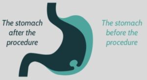 Gastric Plication in Riyadh Chart
