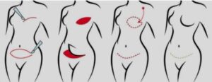 DIEP Flap Breast Reconstruction in Riyadh Chart