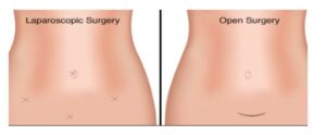 Laparoscopic Surgeries in Riyadh Picture