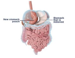 Sleeve Gastrectomy in Riyadh pic